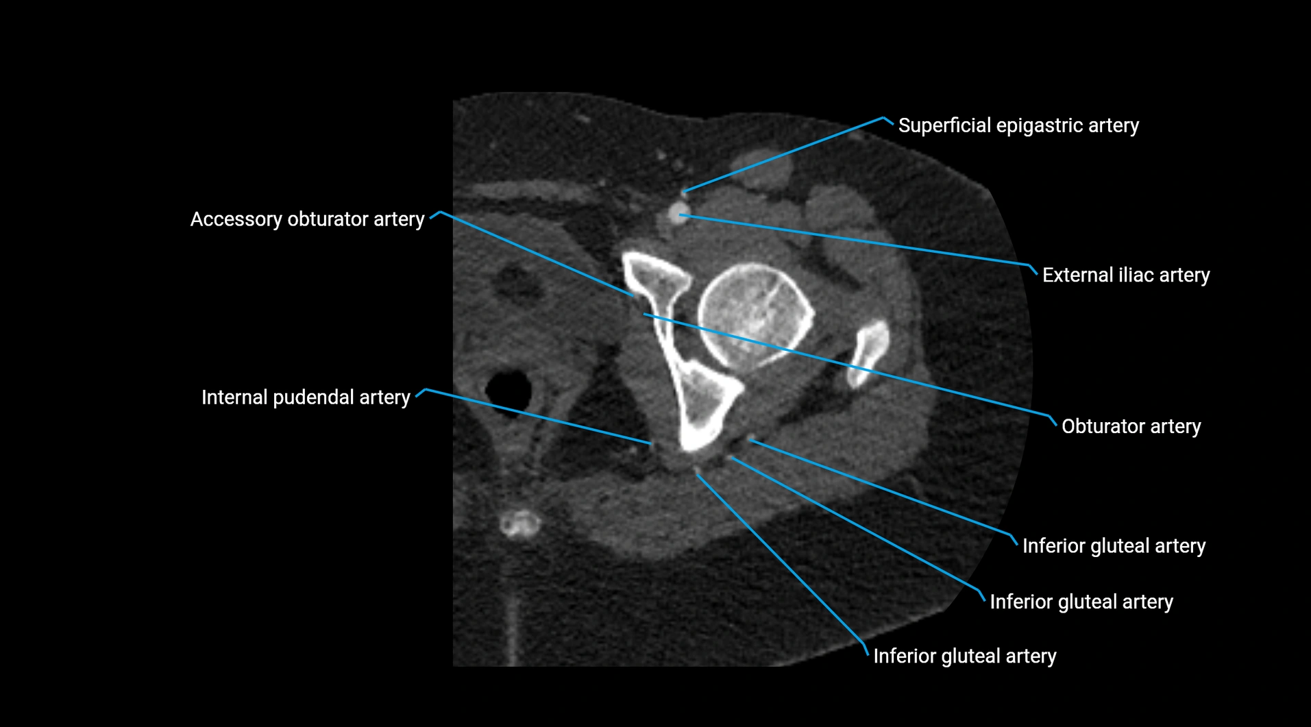 CTA lower limb cross sectional anatomy labelled image _57.webp